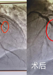 【生死（sǐ）時速 為生命護航】心梗患者感激送錦旗