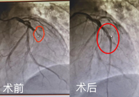 【生死時速 為生命護航】心梗患者感激送錦旗（qí）