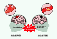 【健（jiàn）康科（kē）普】武寧縣人民醫院內二科：卒中（zhōng）識別早，救治效果好！