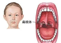 【健康科（kē）普】兒童扁桃體、腺樣體腫大，要手術嗎？